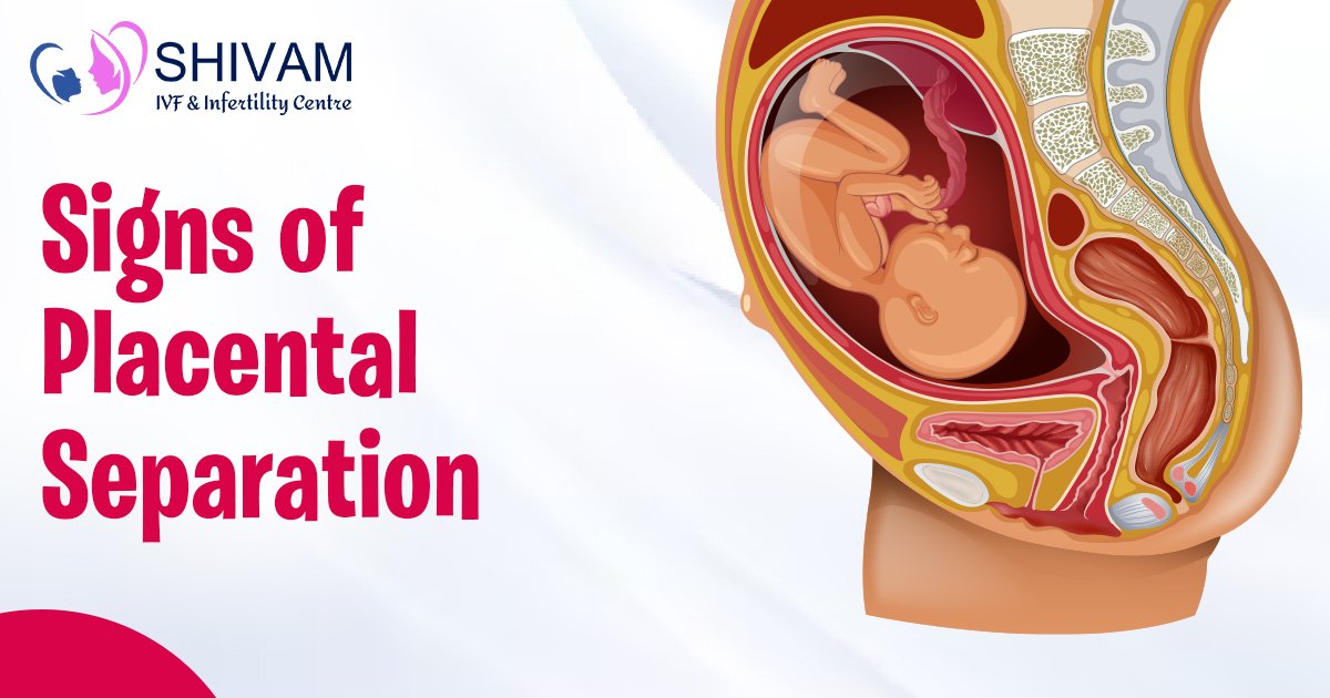 Signs of Placental Separation, Placental abruption, A sign of placental separation, What is a placental abruption, What is a placental separation